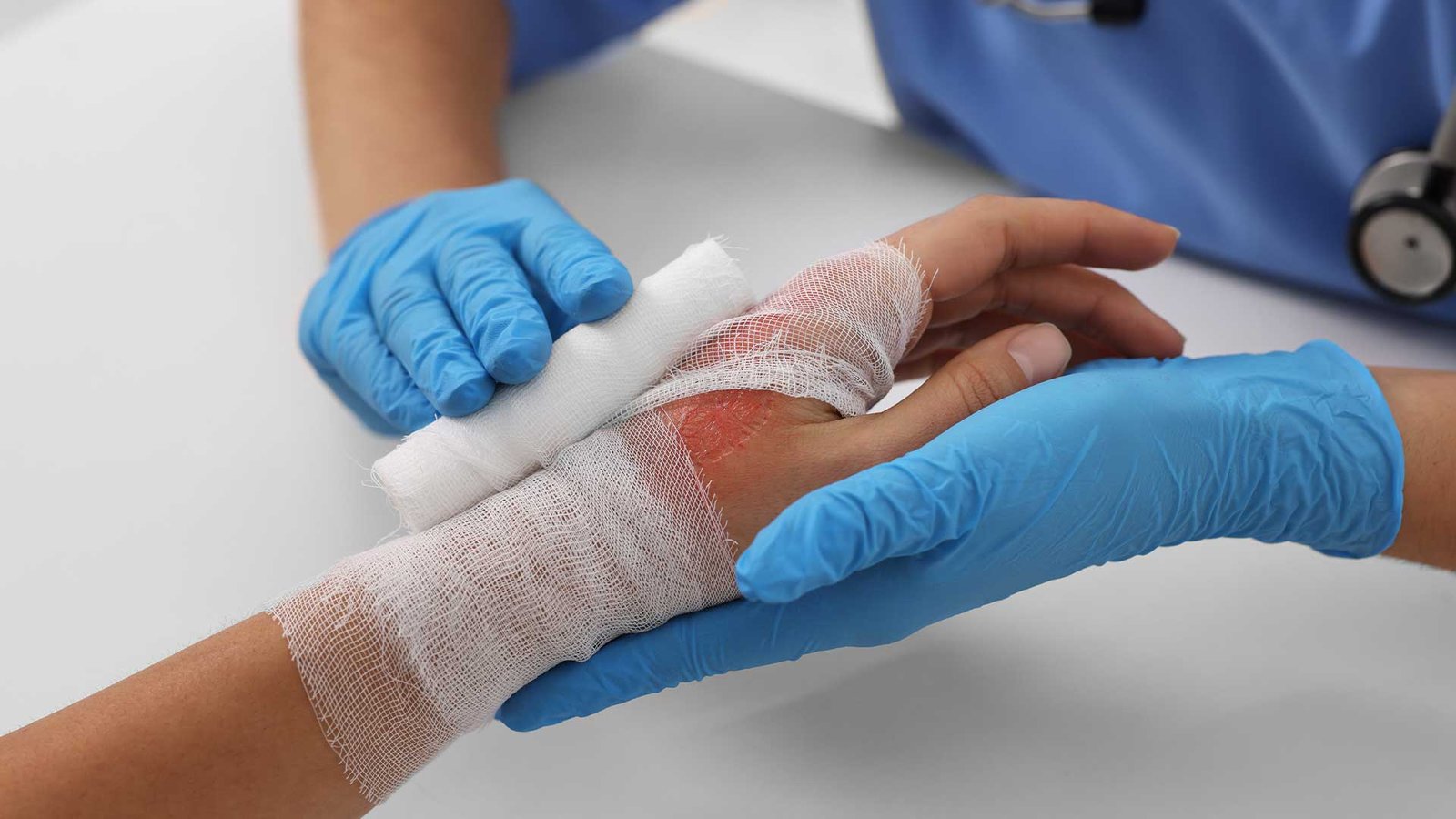 What Determines the Degree of a Burn Injury? What Determines the Degree of a Burn Injury?