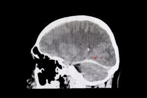 Queens traumatic brain injury lawyer
